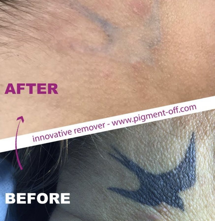 Entfernung von Permanent Make-up